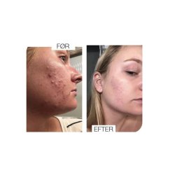 Breakout Clearing Foaming Wash - Clear Start Dermalogica